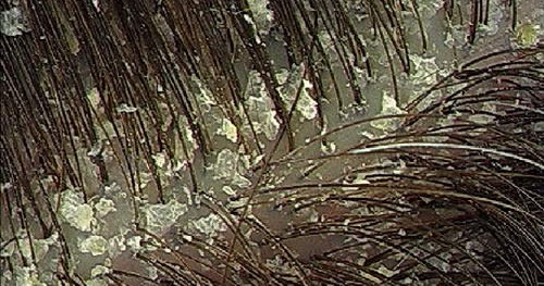 cara merawat ketombe