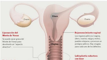 ESTOS SON LOS PROCEDIMIENTOS ESTETICOS QUE SE PUEDEN HACER EN LA VAGINA Y EN ZONAS QUE LA CIRCUNDAN