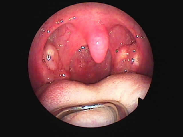 tonsils discharge