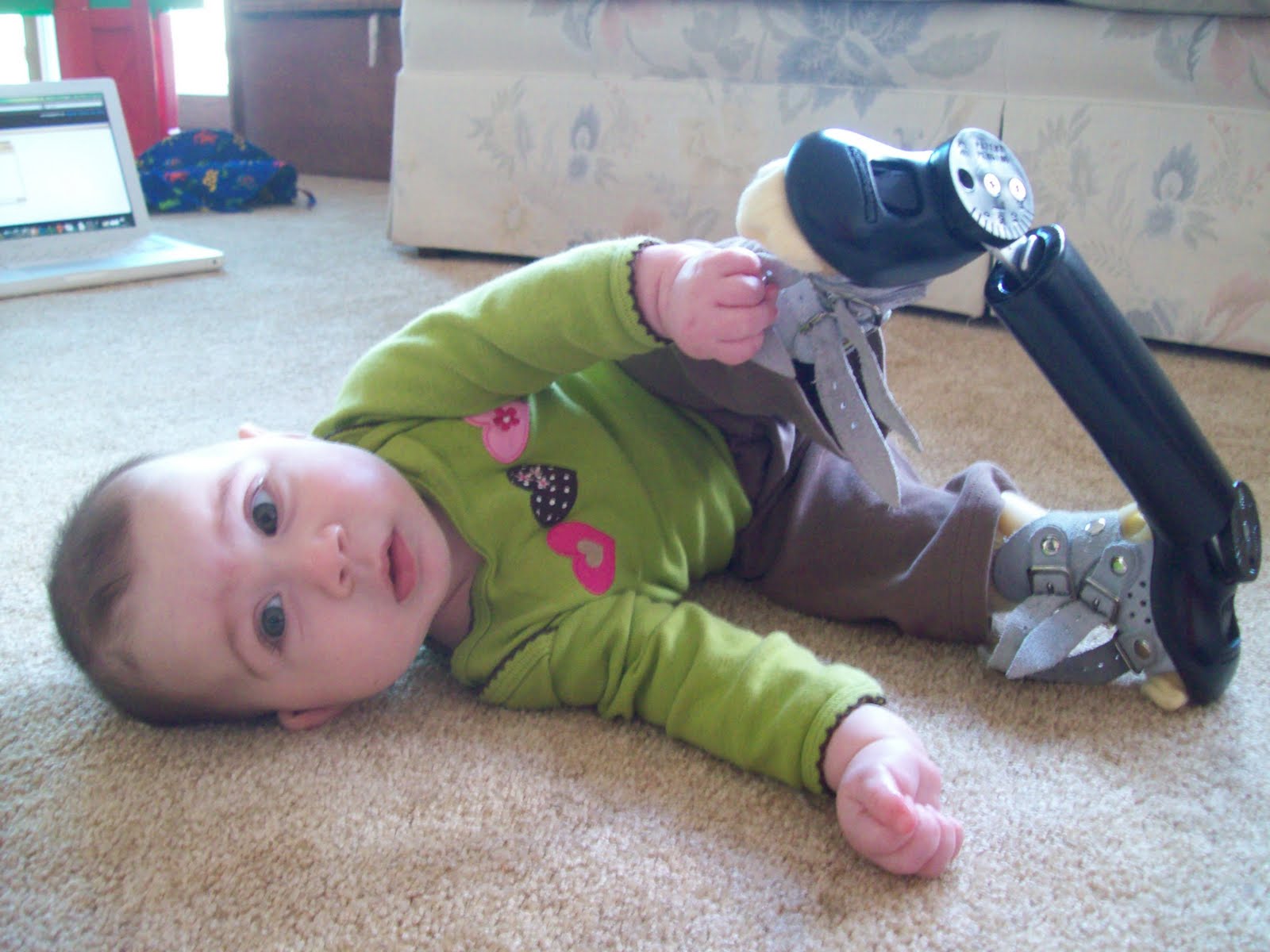 After Dobbs Bar Clubfoot Treatment Images Frompo