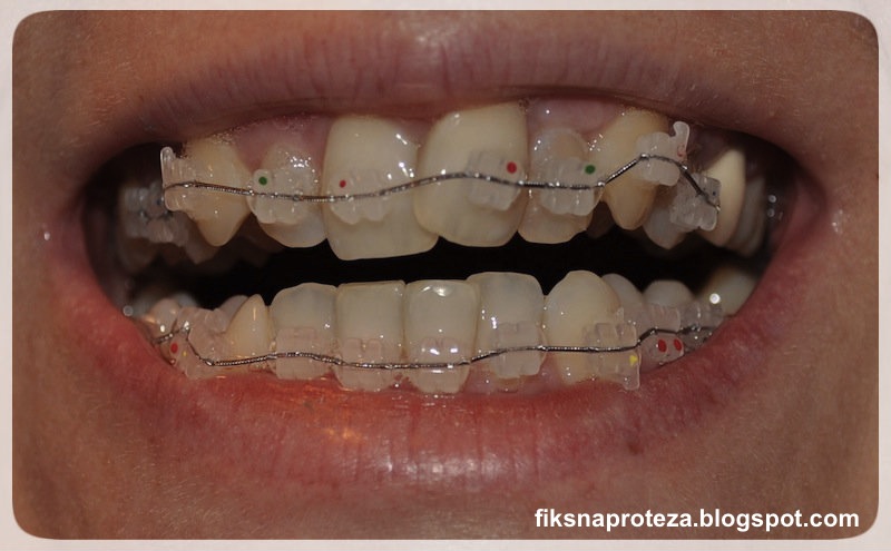 Iva u svetu Fiksne Proteze: Vrste fiksne proteze