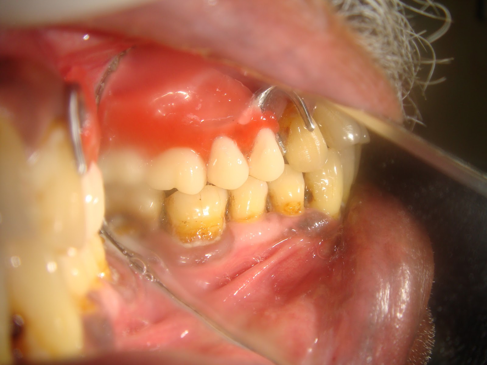 Step by step Guide for Understanding the Prosthodontics A step by step