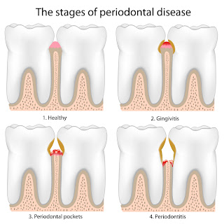 Periodontal Health and Heart Disease