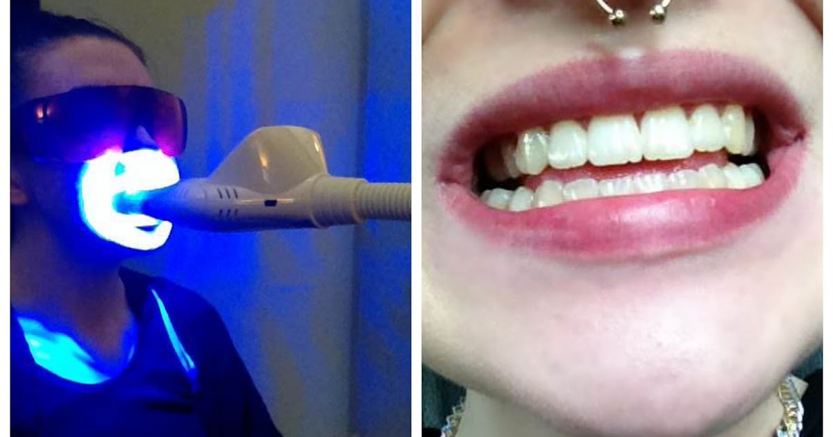 Megawhite Teeth Whitening at Zenergy Clinic Review