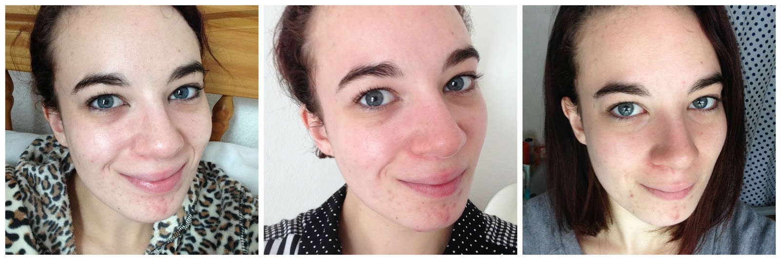 La Roche Posay Effaclar Duo With Before And After Pictures