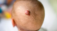 picture of Hemangioma of Skin