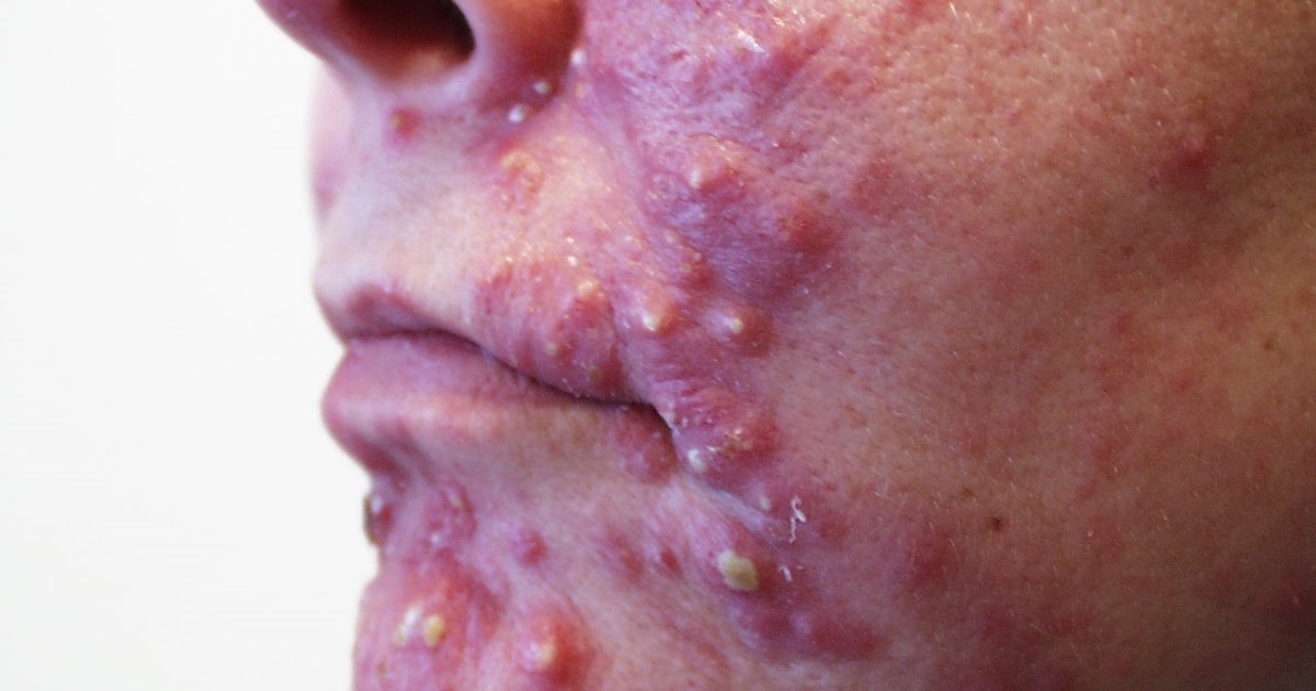 Natural Face Wash For Cystic Acne Natural Face Wash For Cystic Acne