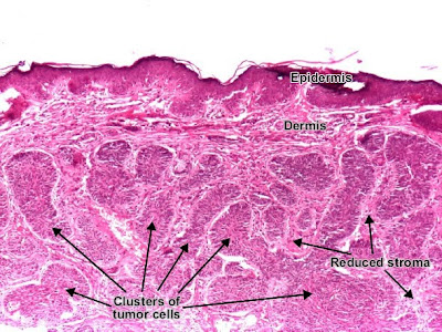Histology and Explanation of Basal cell carcinoma
