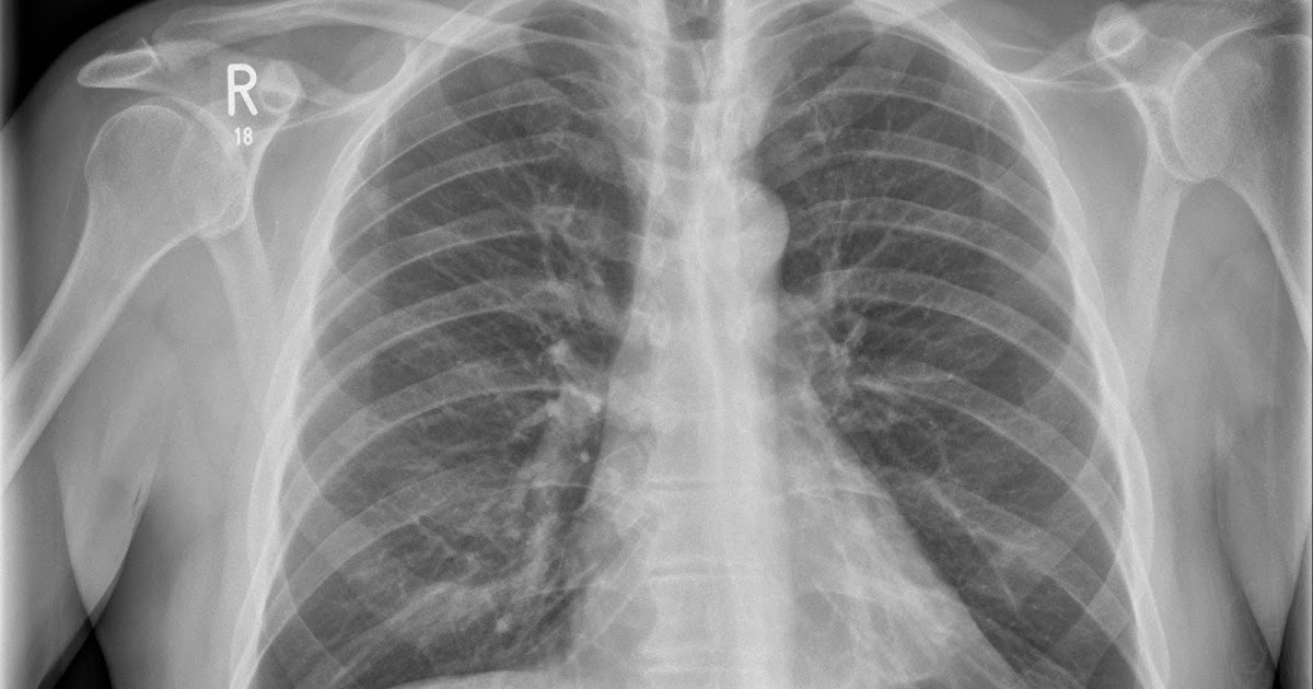 the xray doctor Abdominal distension do the xrays tell the xray doctor Abdominal distension do the xrays tell