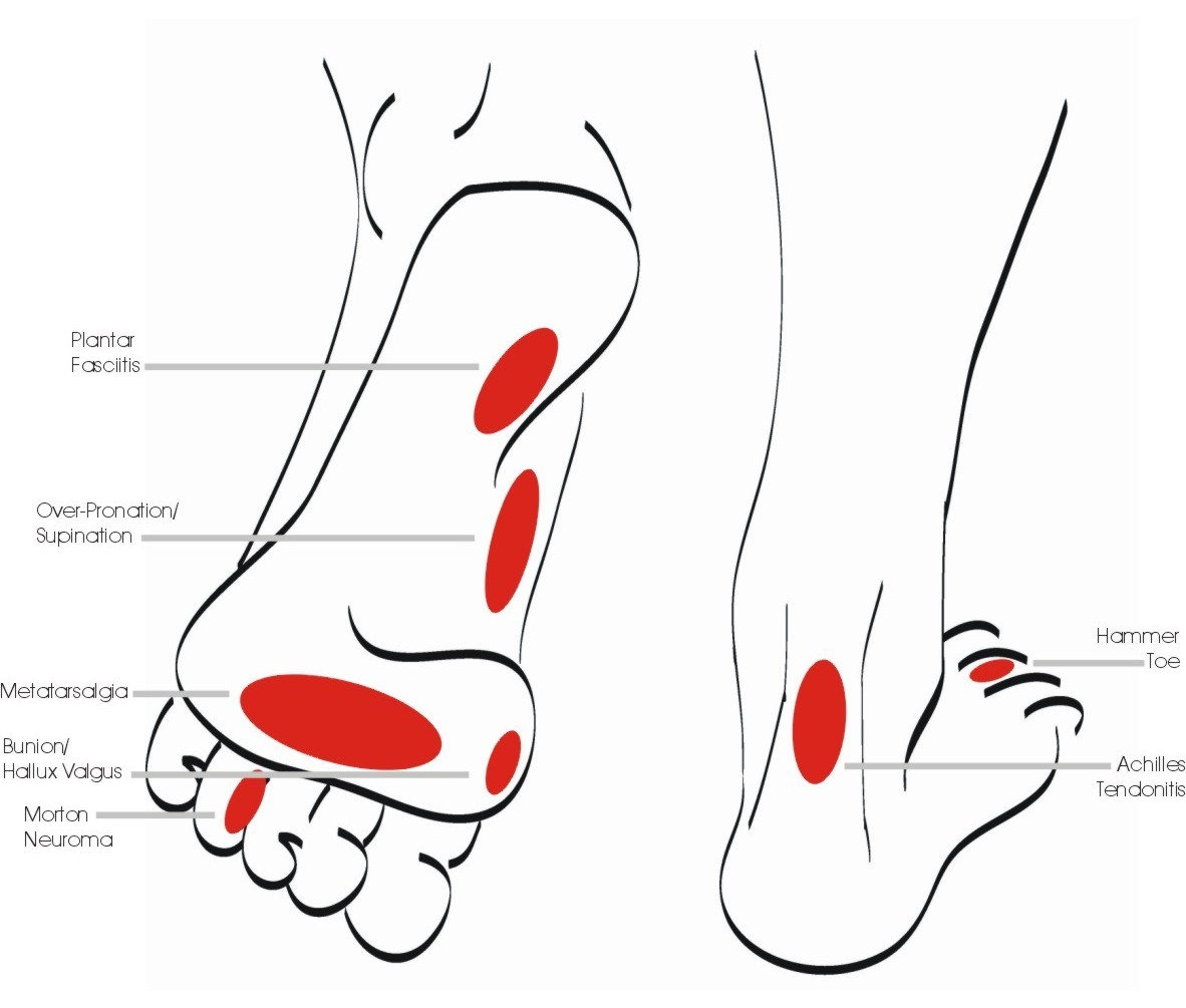 Dr. Sandro Ascenço Fisioterapeuta Metatarsalgia causa dor e faz