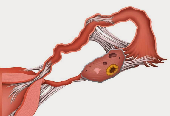 Ilustrasi Saluran Indung Telur