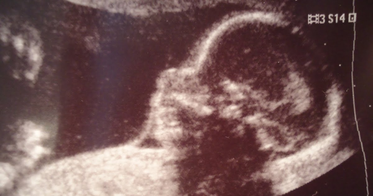 make &quot;womb&quot; for baby The 20 week Ultrasound