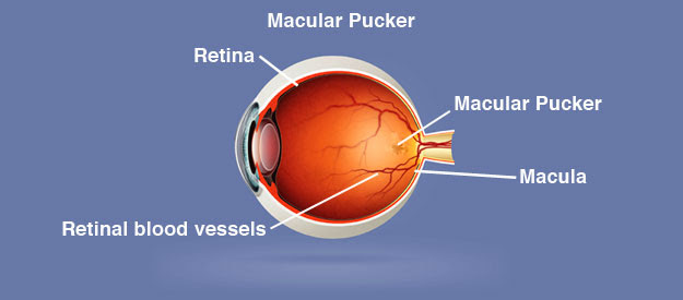 Macular Pucker Natural Treatment Macular Pucker Natural Treatment