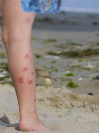 Flea Bites on Children