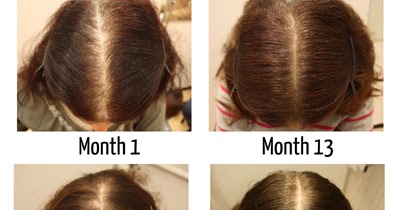 Pharmacy Talks Treatments And Healthy Maintenance Of Hair Loss