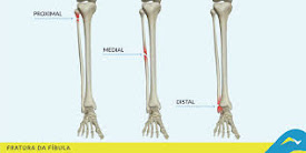 Fisioterapia - Recuperação de fraturas