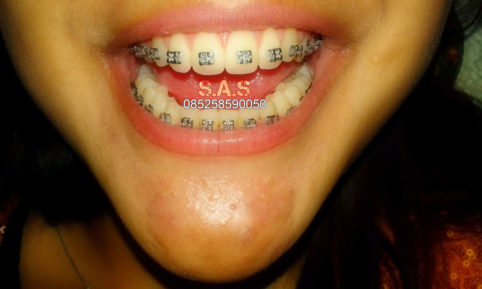 S.A.S AHLI GIGI KOTA PATI, Jateng &amp; KOTA JEMBER, Jatim