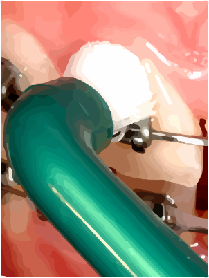 Orthodontic toothbrush