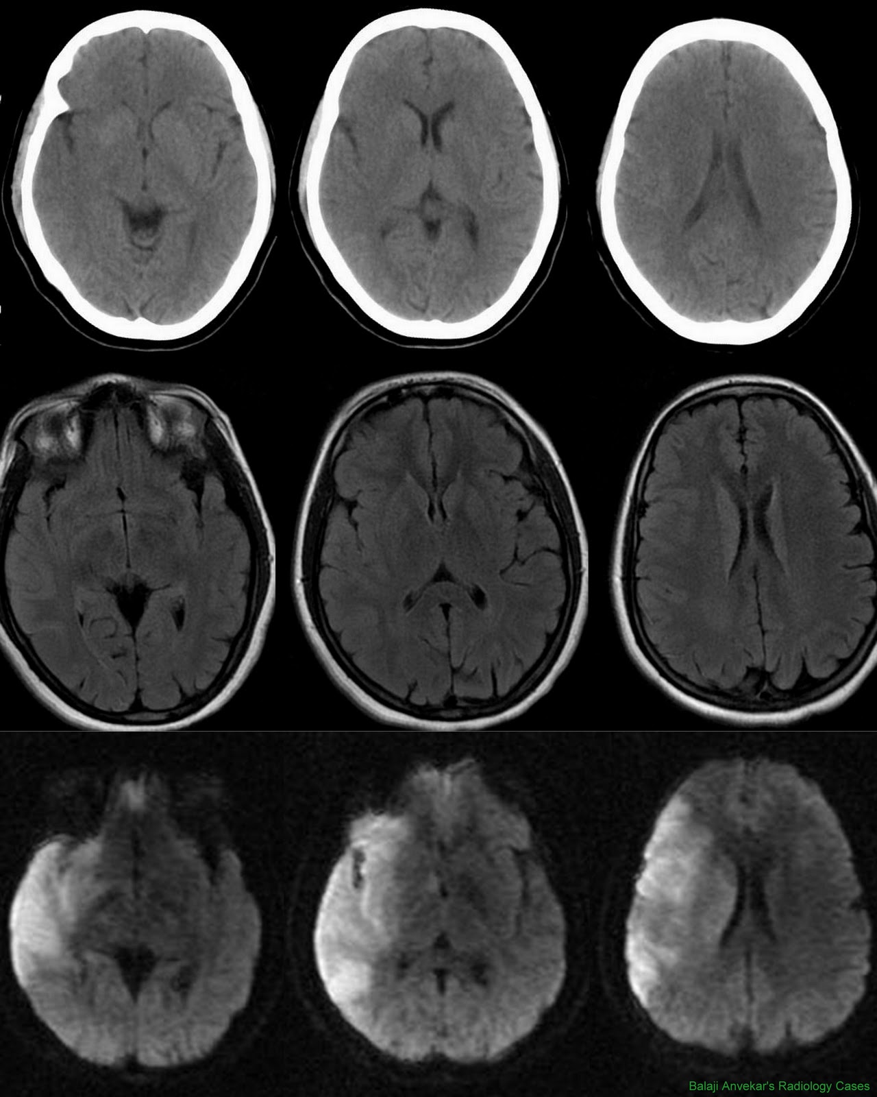 infarct involving the left basal ganglia infarct involving the left basal ganglia