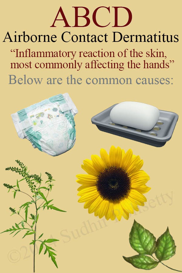 Sudhir Polisetty's General Dermatology Blog Airborne Contact Dermatitis in the USA