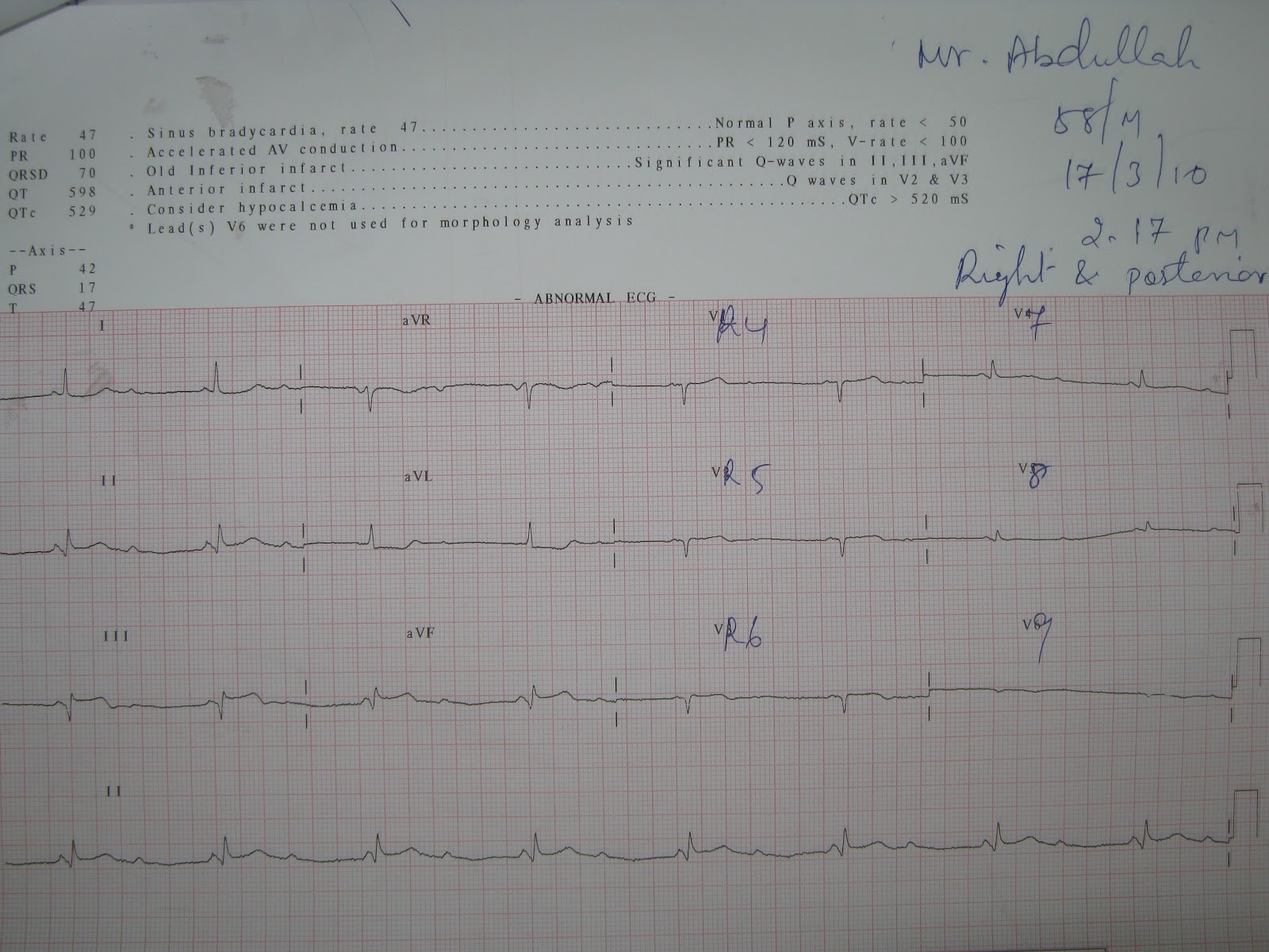 Medical Images Gallery Inferior Wall Myocardial Infarction ECG