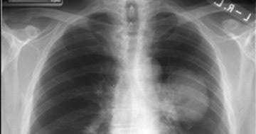 lung