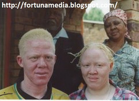 PHOTO;Kisah Derita Orang Albino Di Afrika,Diburu Untuk Diambil Bagian Tubuhnya PHOTO;Kisah Derita Orang Albino Di Afrika,Diburu Untuk Diambil Bagian Tubuhnya