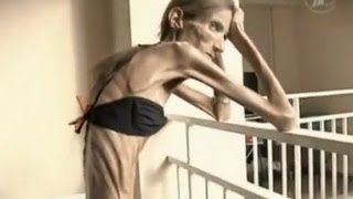 Skinniest Woman In The World
