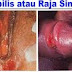 Obat Sipilis Ampuh Herbal Yang Paling Manjur thumbnail