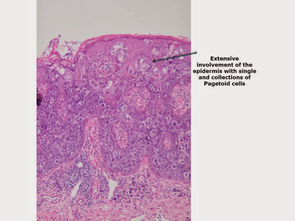 Consultations in Dermatology Extramammary Paget's Disease