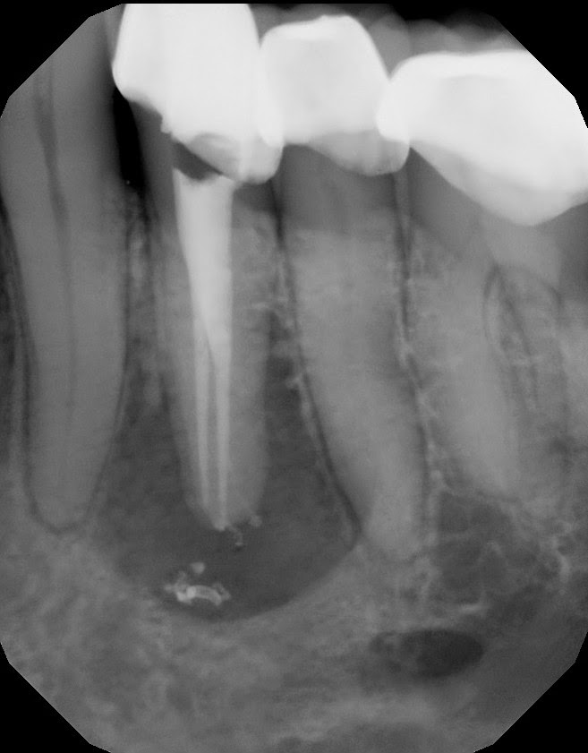 The Endo Blog CBCT in Endodontics to Treat Difficult Anatomy