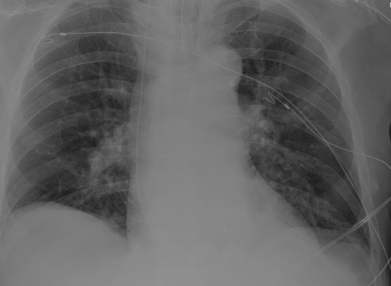 Dr. Smith's ECG Blog Emergency Transvenous Cardiac Pacing