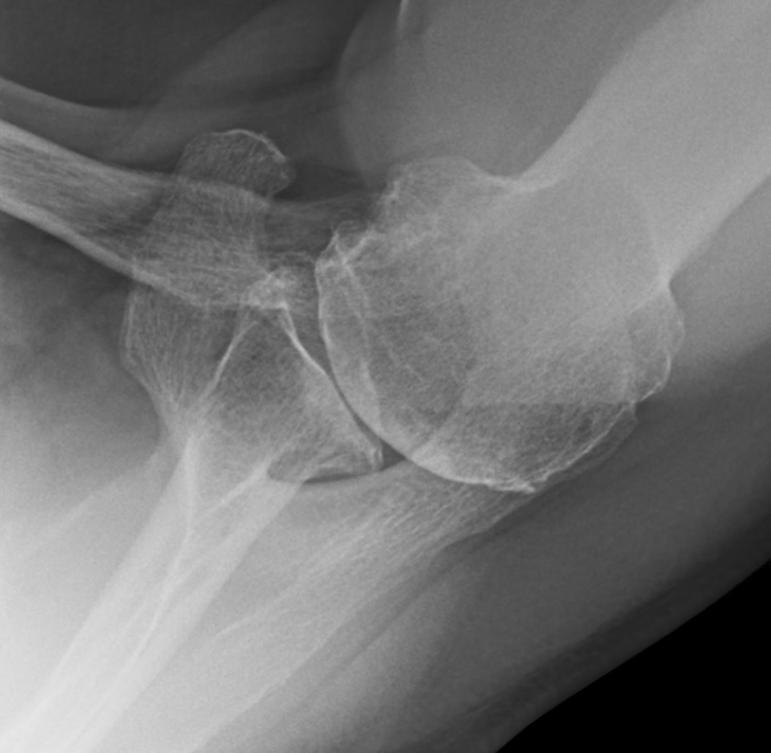 Shoulder Arthritis / Rotator Cuff Tears causes of shoulder pain How