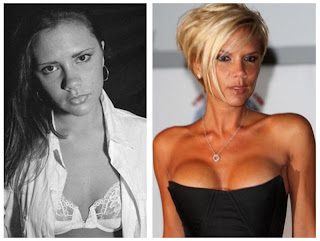 Breast Implants Before After