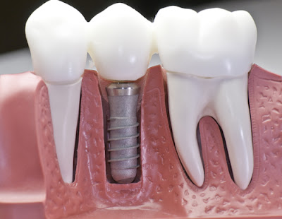 Dental implants teeth