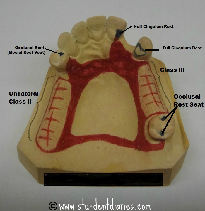 StuDENT Diaries Fabrication of Removable Partial Dentures