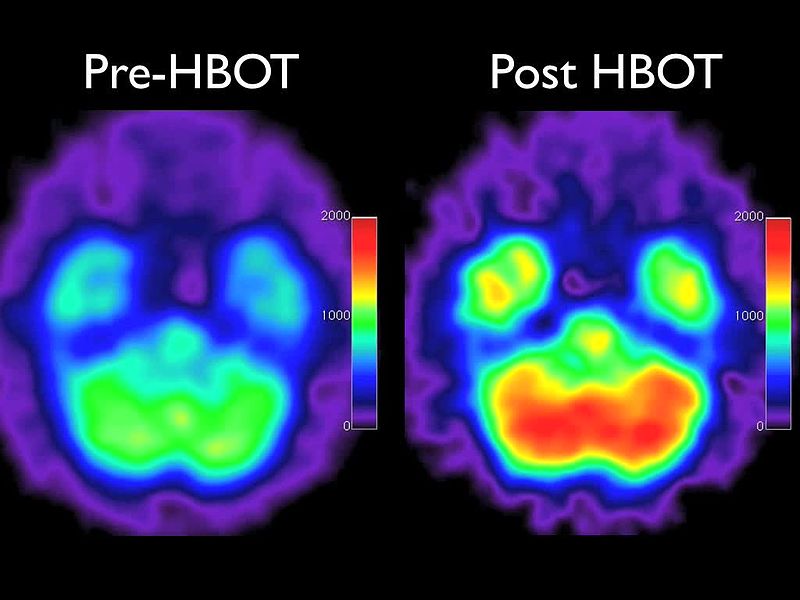 Emerson Villela Carvalho Jr., M.D. Hyperbaric oxygen therapy for