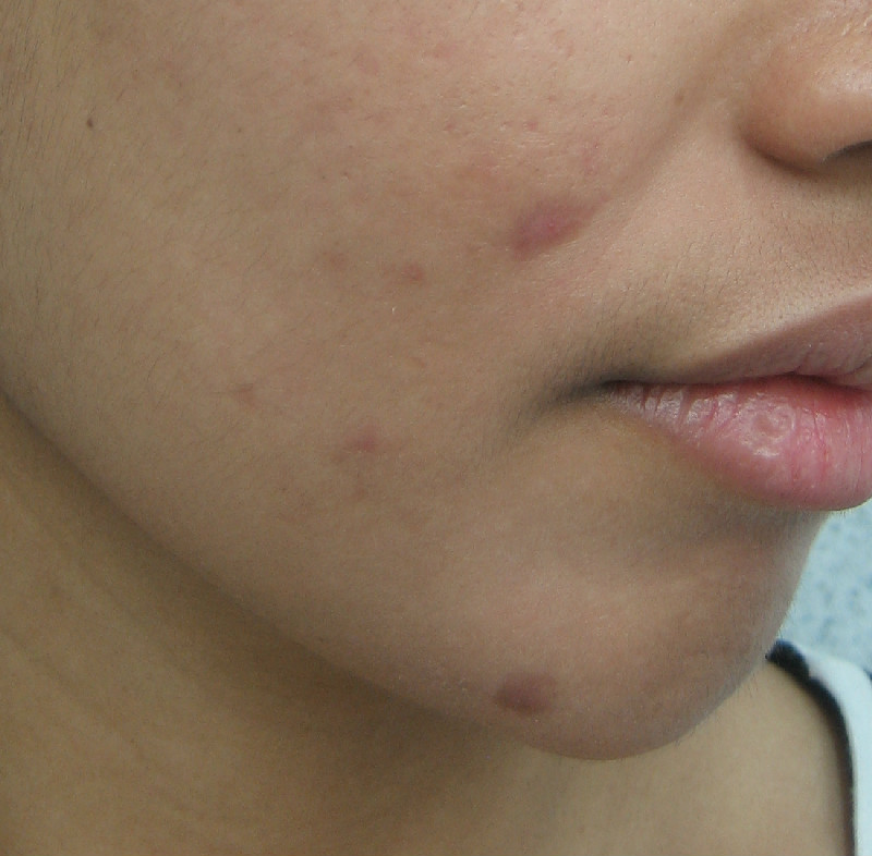 Adult european tv shows Adult acne face