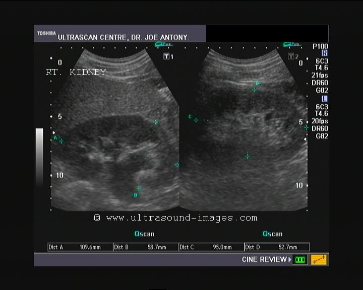 cochinblogs kidney stones renal calculi urinary stones size of kidney stones