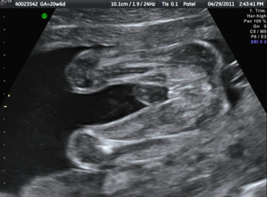 ultrasound vs sonogram ultrasound vs sonogram