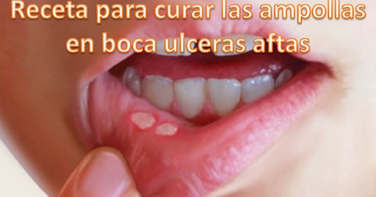 Receta Para Curar Las Ampollas De La Boca Ulceras Aftas la salud es