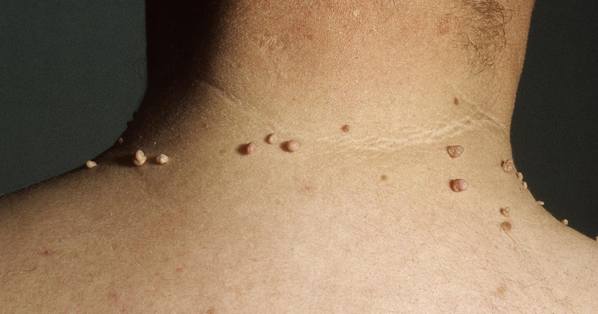 20 Simple Home Remedies for Skin Tag Removal / how to cure maru