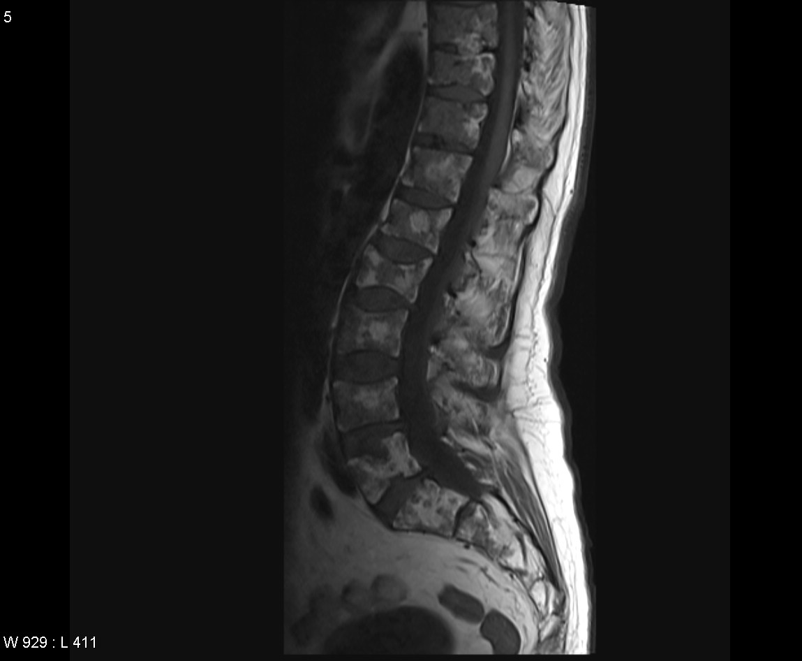 multiple myeloma ct brain