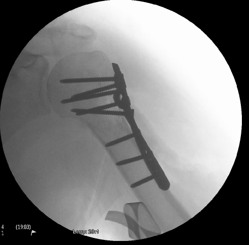 treatment torus fracture humerus treatment torus fracture humerus