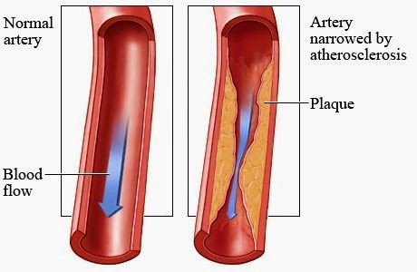 Чистый кровеносный сосуд и сосуд с холестерином Чистый кровеносный сосуд и сосуд с холестерином
