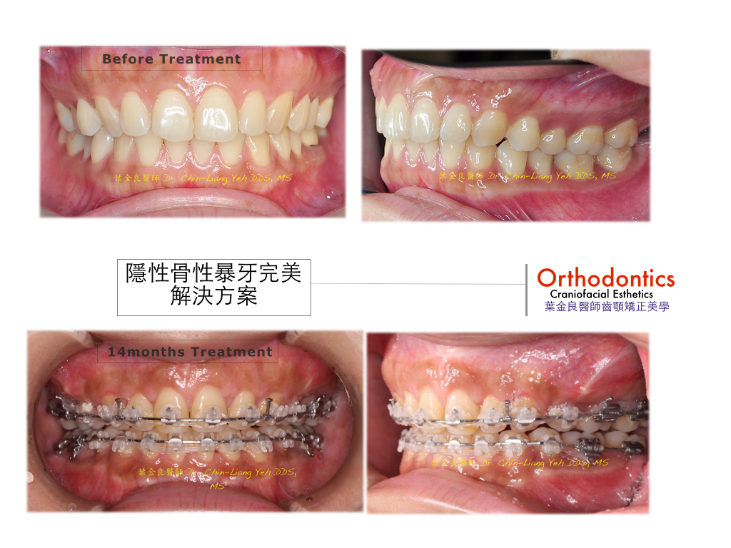 矯正案例 - 暴牙合併深咬 - 台南北區牙醫推薦綠芽牙醫診所