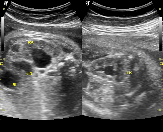 Ultrasound imaging Sonography of a case of bilateral fetal hydronephrosis