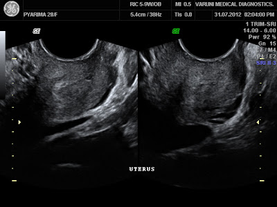 Radiodiagnosis - Imaging is Amazing-Interesting cases: Live ectopic