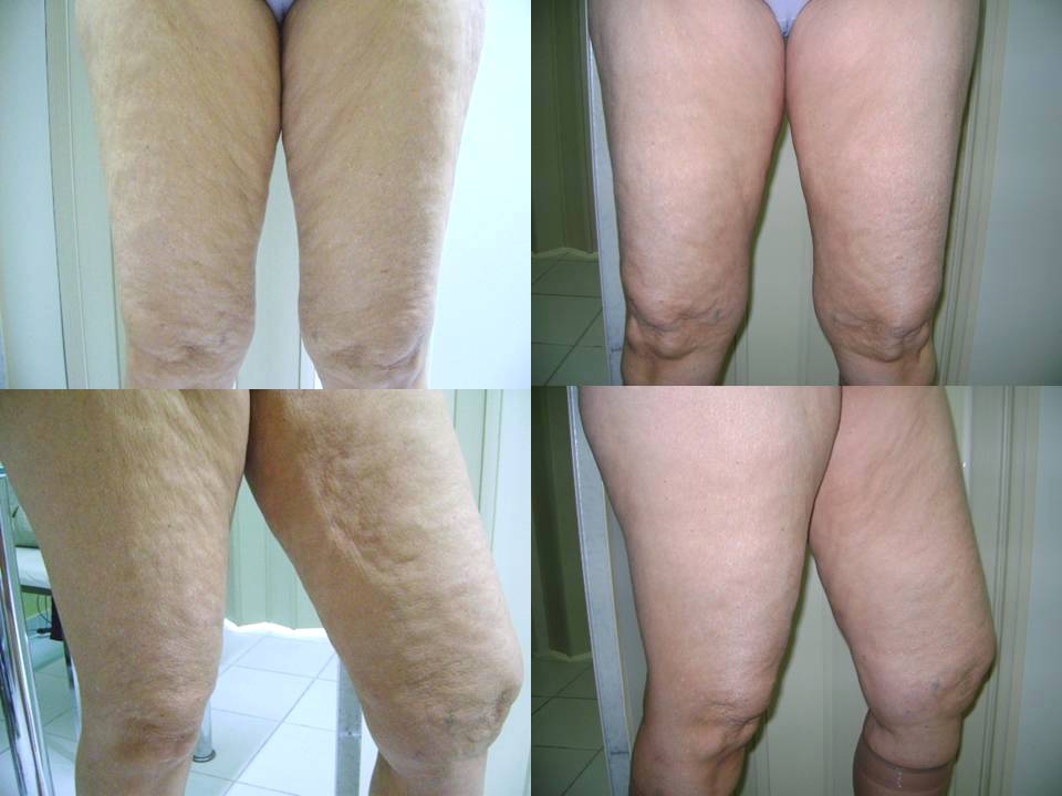 Biomed Estética: Tratamentos para Flacidez Muscular e Cutânea - Saiba a