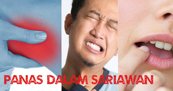 Cara Mengobati dan Meredakan Panas Dalam Cara Mengobati dan Meredakan Panas Dalam